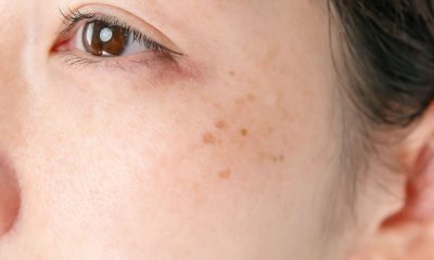 Understanding Pigmentation Problems in Skin: Causes and Treatment Approaches