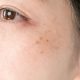 Understanding Pigmentation Problems in Skin: Causes and Treatment Approaches
