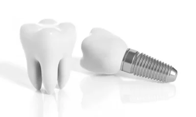 Comprehensive Benefits of Dental Implants