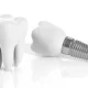Comprehensive Benefits of Dental Implants