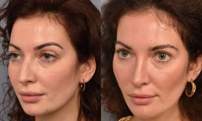 Buccal Fat Removal: What It Is, Recovery & Before & After