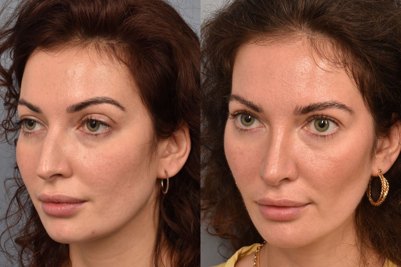 Buccal Fat Removal: What It Is, Recovery & Before & After 26 Buccal Fat Removal: What It Is, Recovery & Before & After