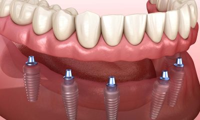 Comprehensive Guide to Full-Mouth Dental Implant Solutions