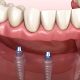 Comprehensive Guide to Full-Mouth Dental Implant Solutions