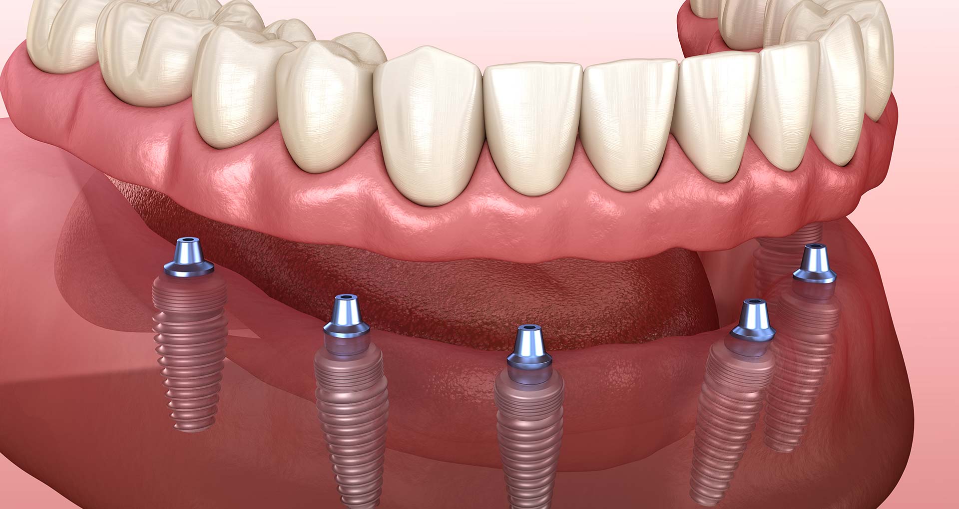 Comprehensive Guide to Full-Mouth Dental Implant Solutions 26 Comprehensive Guide to Full-Mouth Dental Implant Solutions