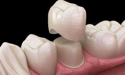 How Same-Day Dental Crowns Are Changing Smiles