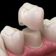 How Same-Day Dental Crowns Are Changing Smiles