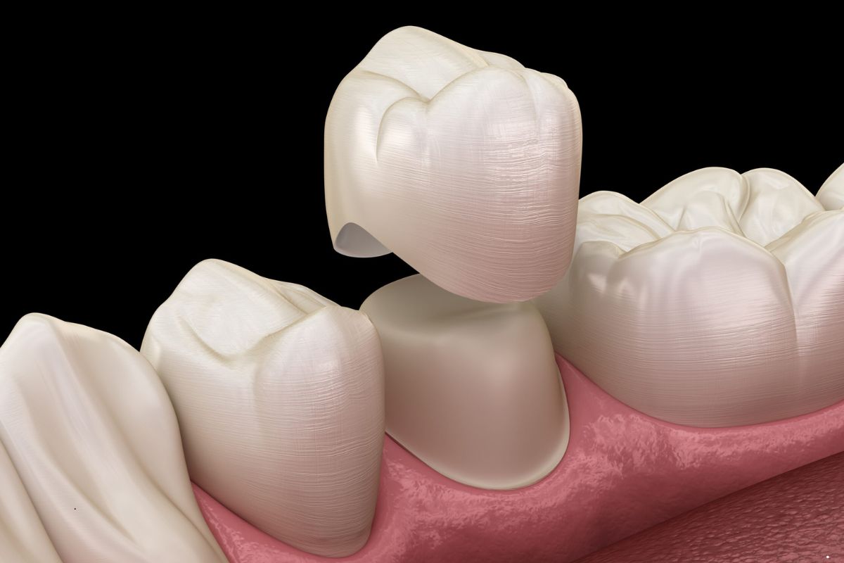 How Same-Day Dental Crowns Are Changing Smiles